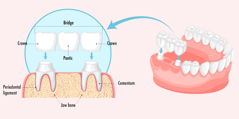 dental crown treatment in Kharadi, Pune | dental bridges treatment in Kharadi, Pune