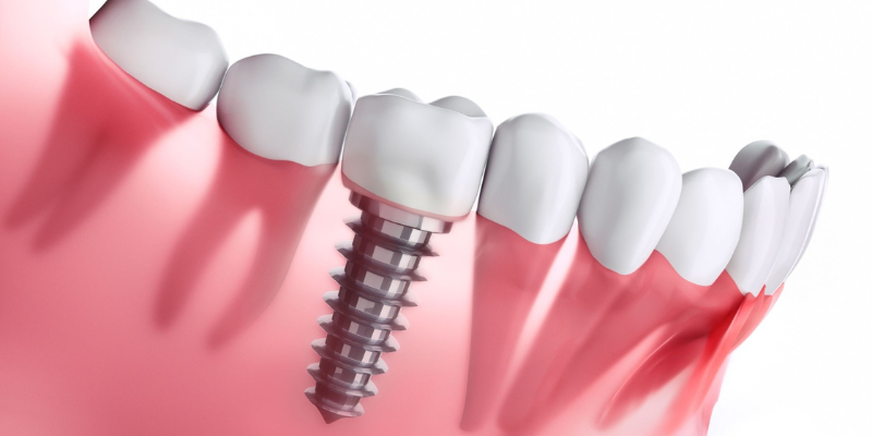 Dental Implants Clinic in Kharadi, Pune | Dental Implants treatment in Kharadi, Pune