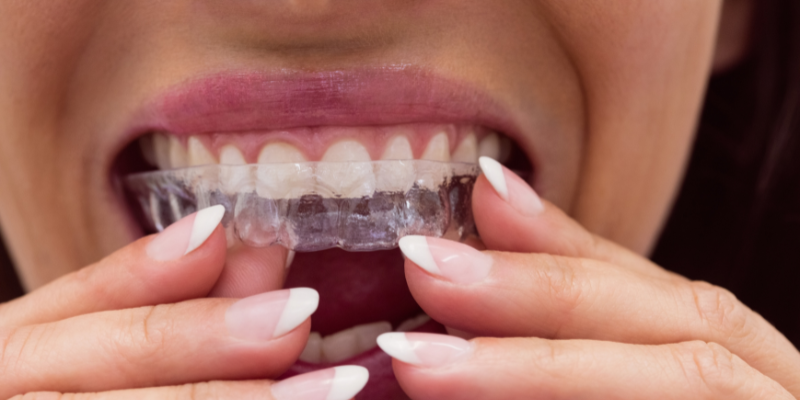 Invisible Braces Clinic in Kharadi, Pune | Invisible Braces Treatment in Kharadi, Pune