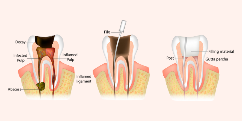 root canal treatment in Kharadi, Pune | root canal clinic in Kharadi, Pune