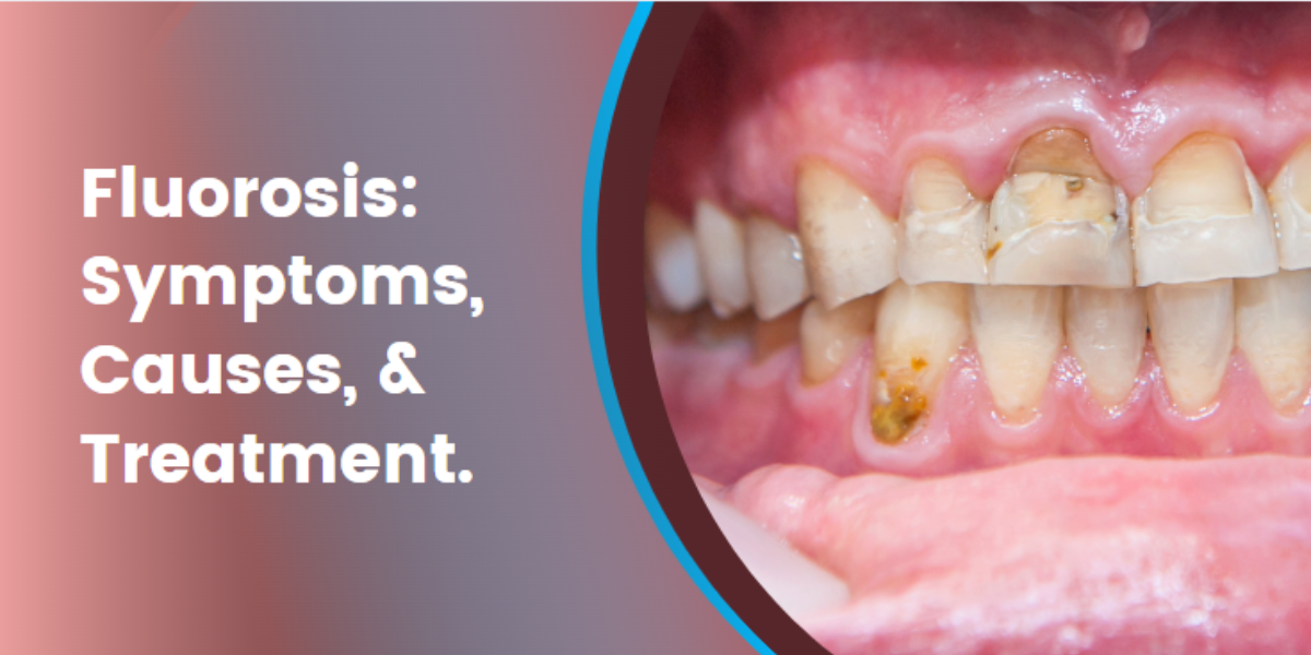 Fluorosis: Symptoms, Causes, & Treatment.