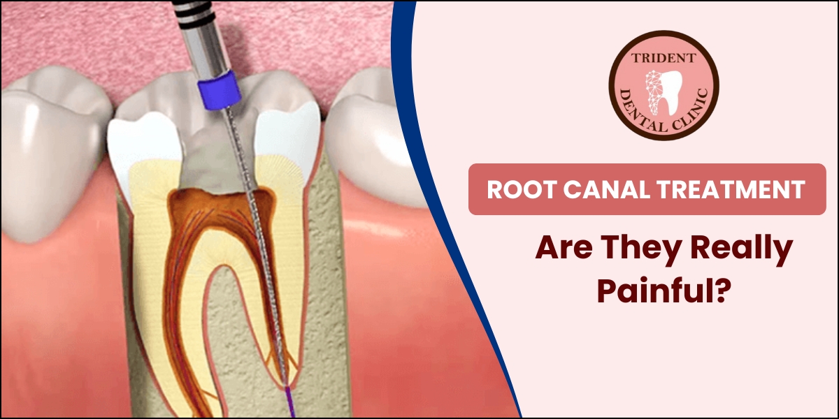 The Truth About Root Canals: Are They Really Painful?