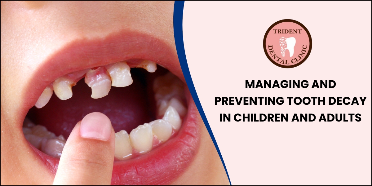 Tips for Managing and Preventing Tooth Decay in Children and Adults